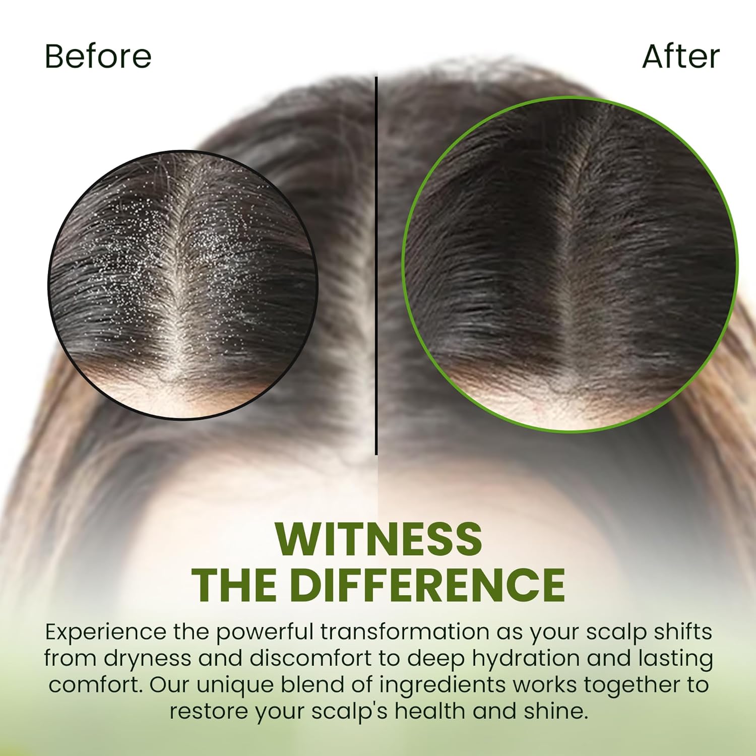 Itchy Scalp Treatment With Tea Tree Oil