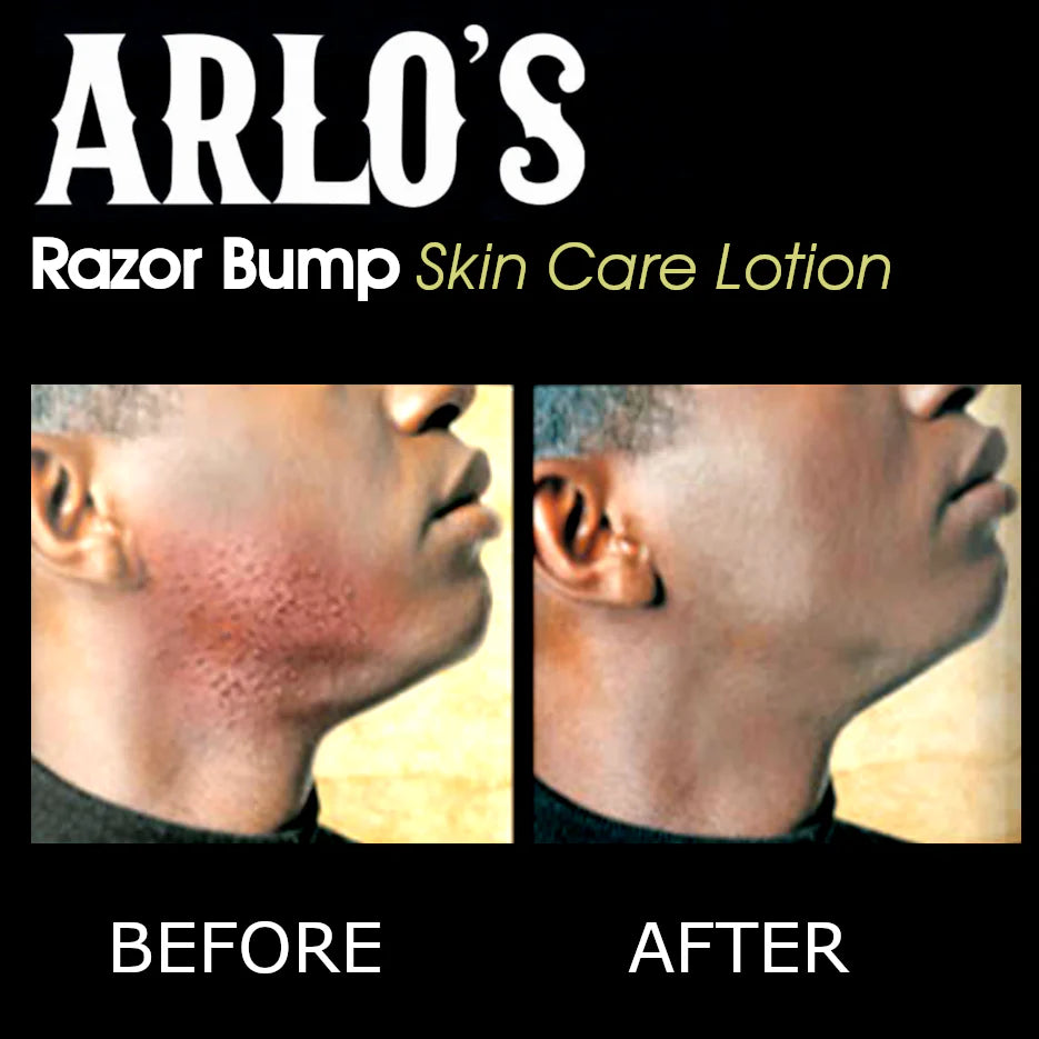 Razor Bump Skin Care Lotion